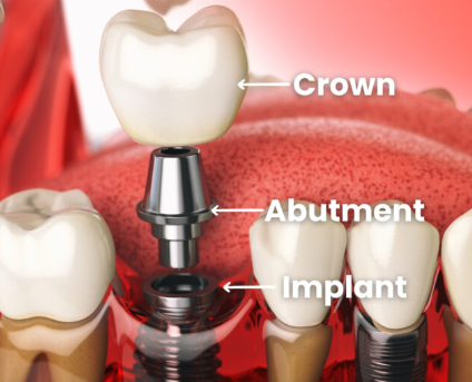임플란트-크라운