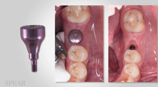 힐링어버트먼트